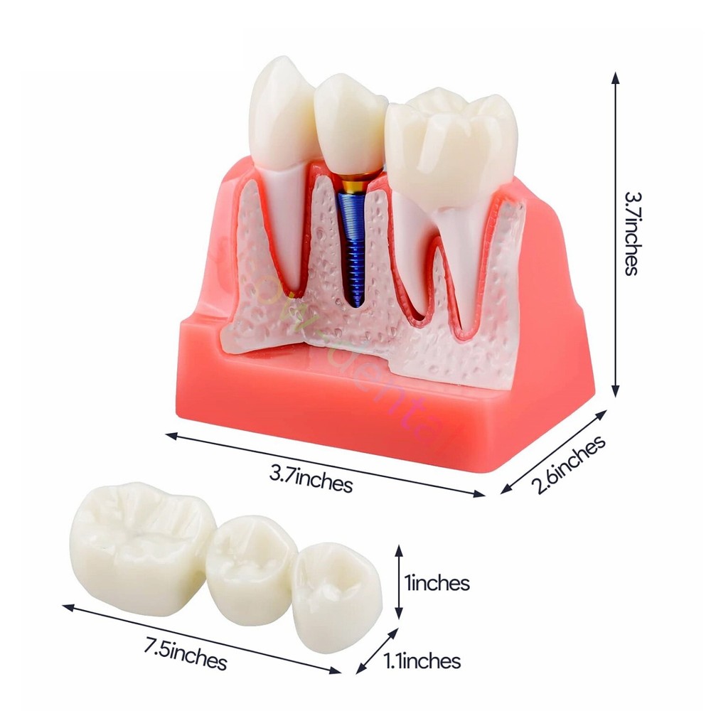 Dental Implant Analysis Removable Crown Teeth Model Analysis Study Model
