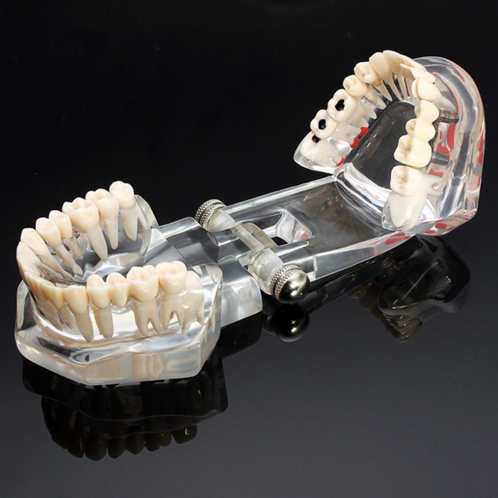 Dental Teeth Model With Restoration&Bridge Implant Disease Study Teaching Model