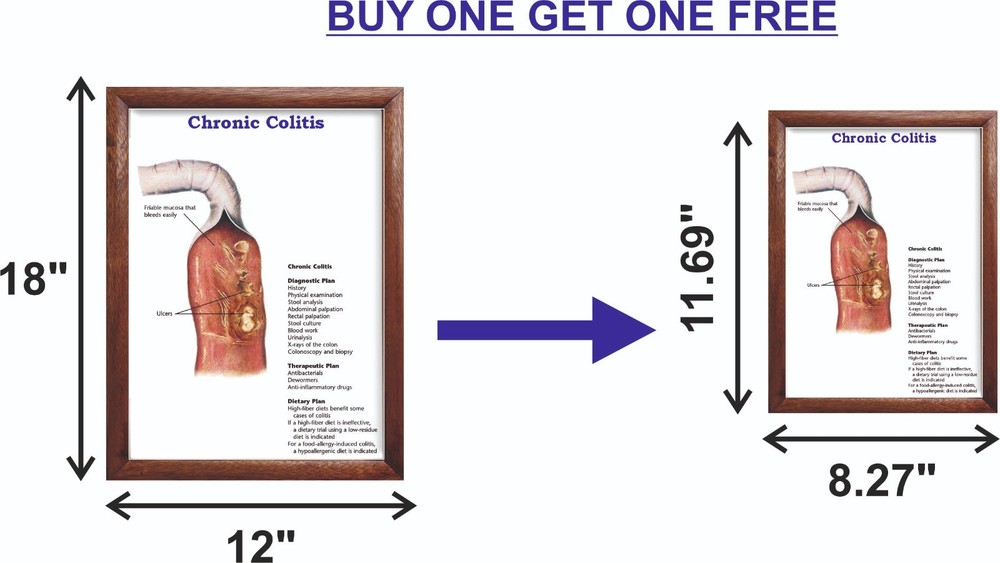 Chronic Colitis Chart 12x18 inches