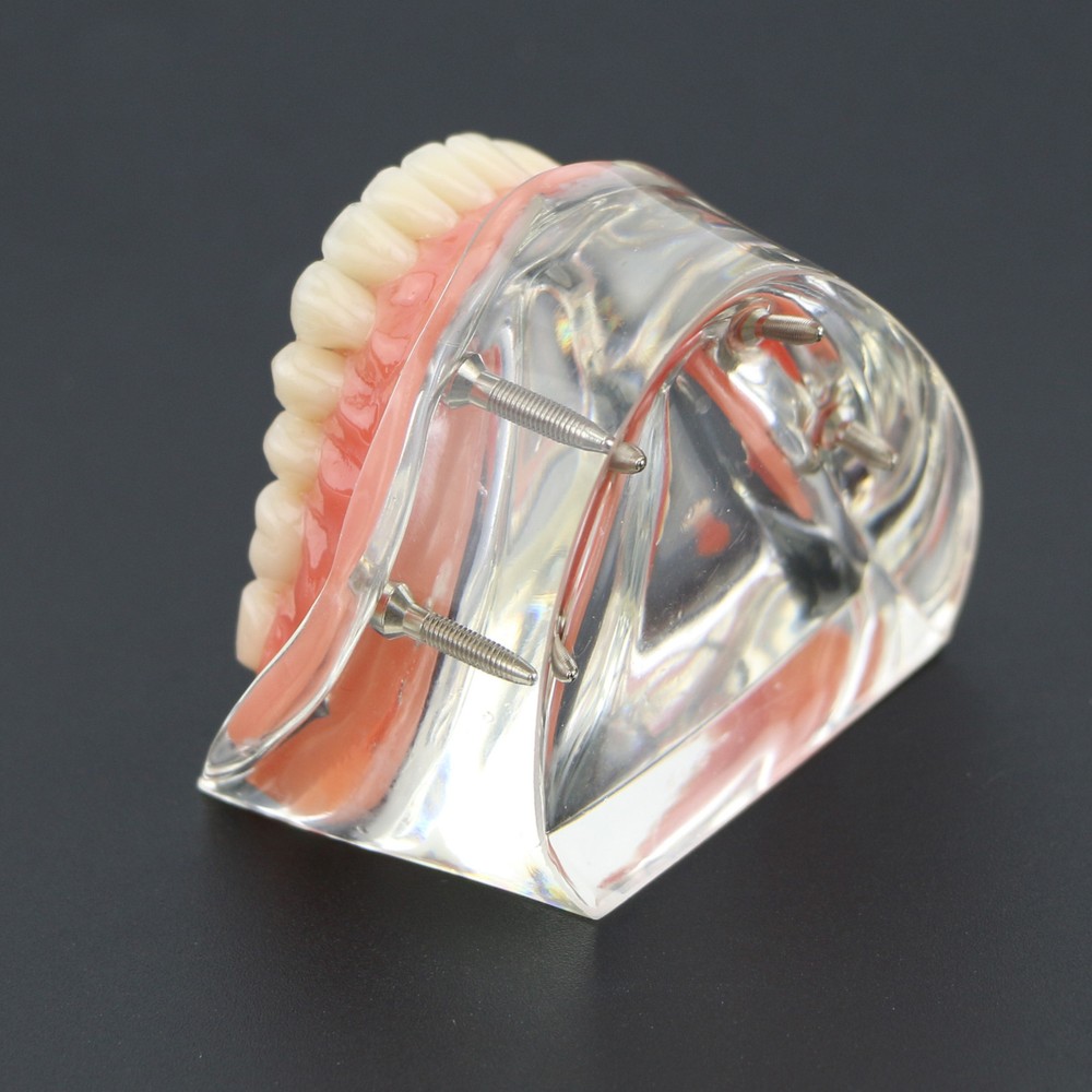 Dental Typodont Lower Teeth Demo Study Model Overdenture Inferior 4 Implants