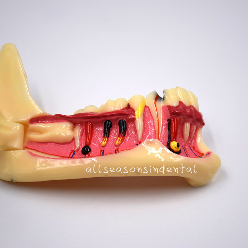 1 Pcs Dental Mandibular Tissue Teeth Anatomical Model Patient Teach Study Model