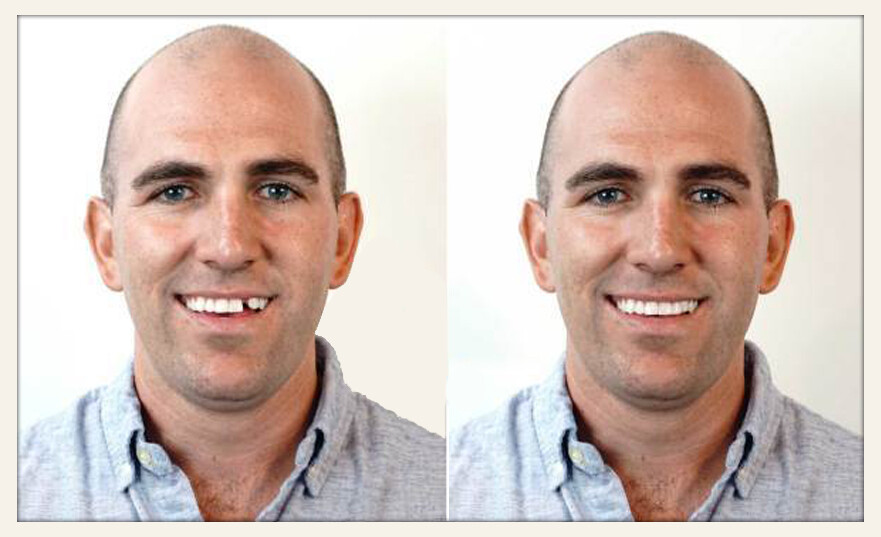 3 Pack Set Instant Smile All Shades Temporary Teeth Replacement Kit