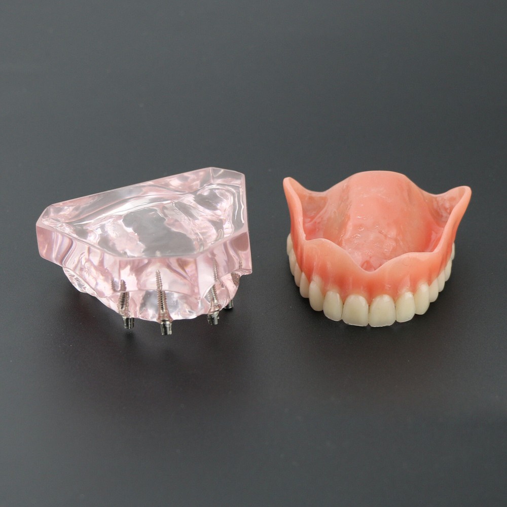 Dental Teeth Model Demo Overdenture Restoration With 4 Implants Upper Maxillary