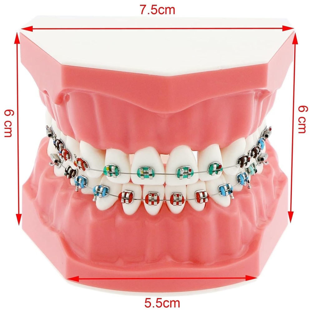Realistic Typodont Orthodontics Model with Metal Brackets - Perfect for Teaching