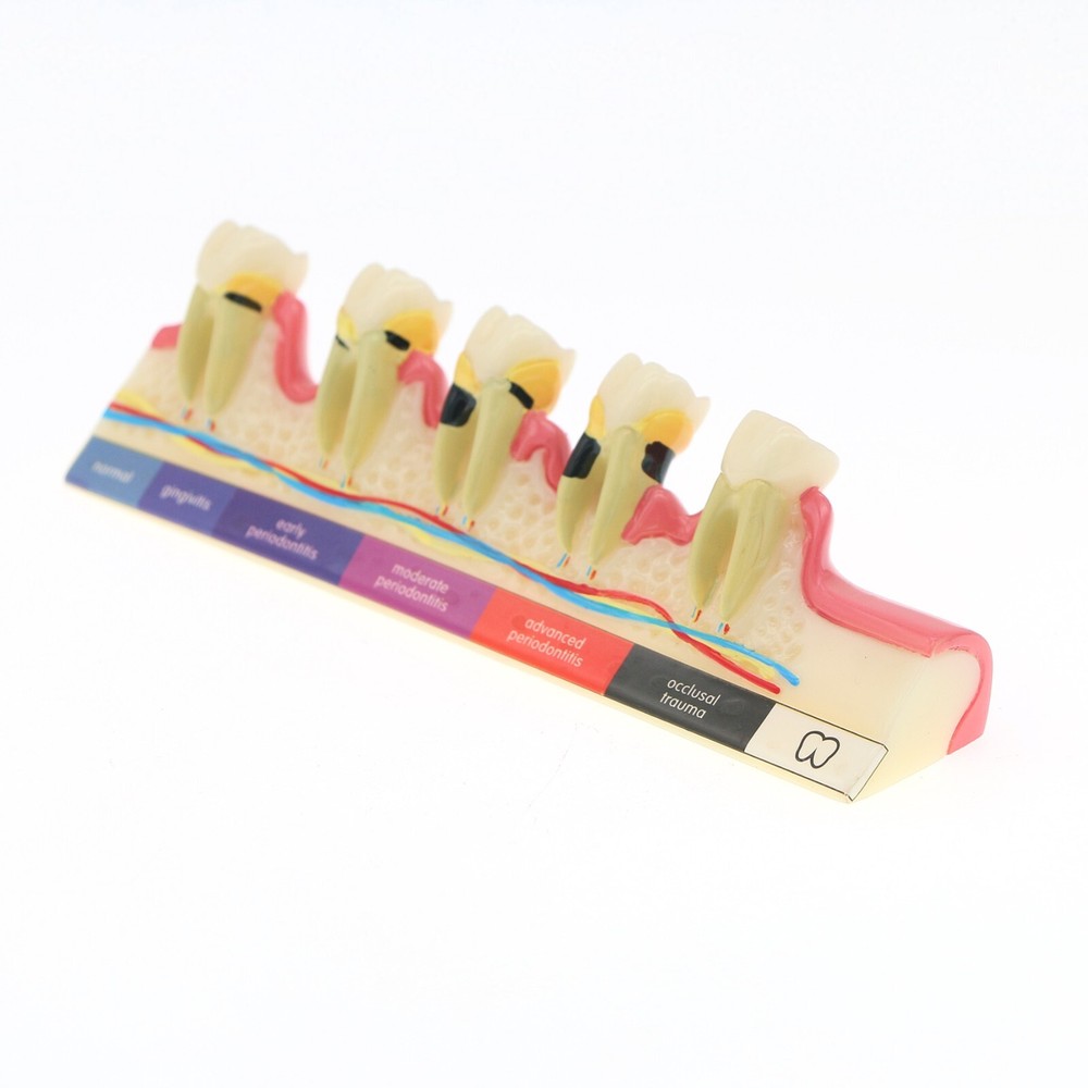 Dental Typodont Teeth Model Pathological Perio Implant Endo Caries Teeth Model