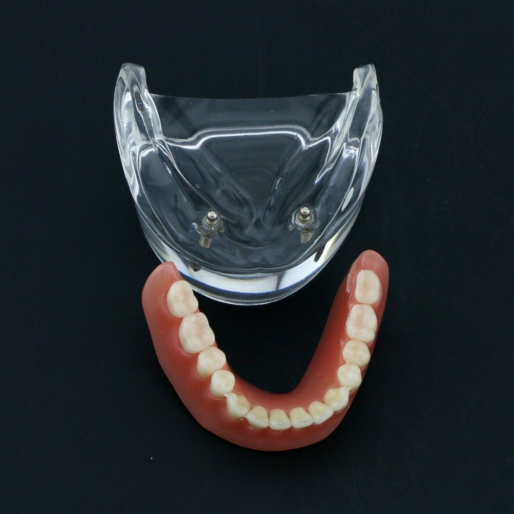 Dental Oral Transparent Upper Teeth 2/4 Implants Model Overdenture Restoration