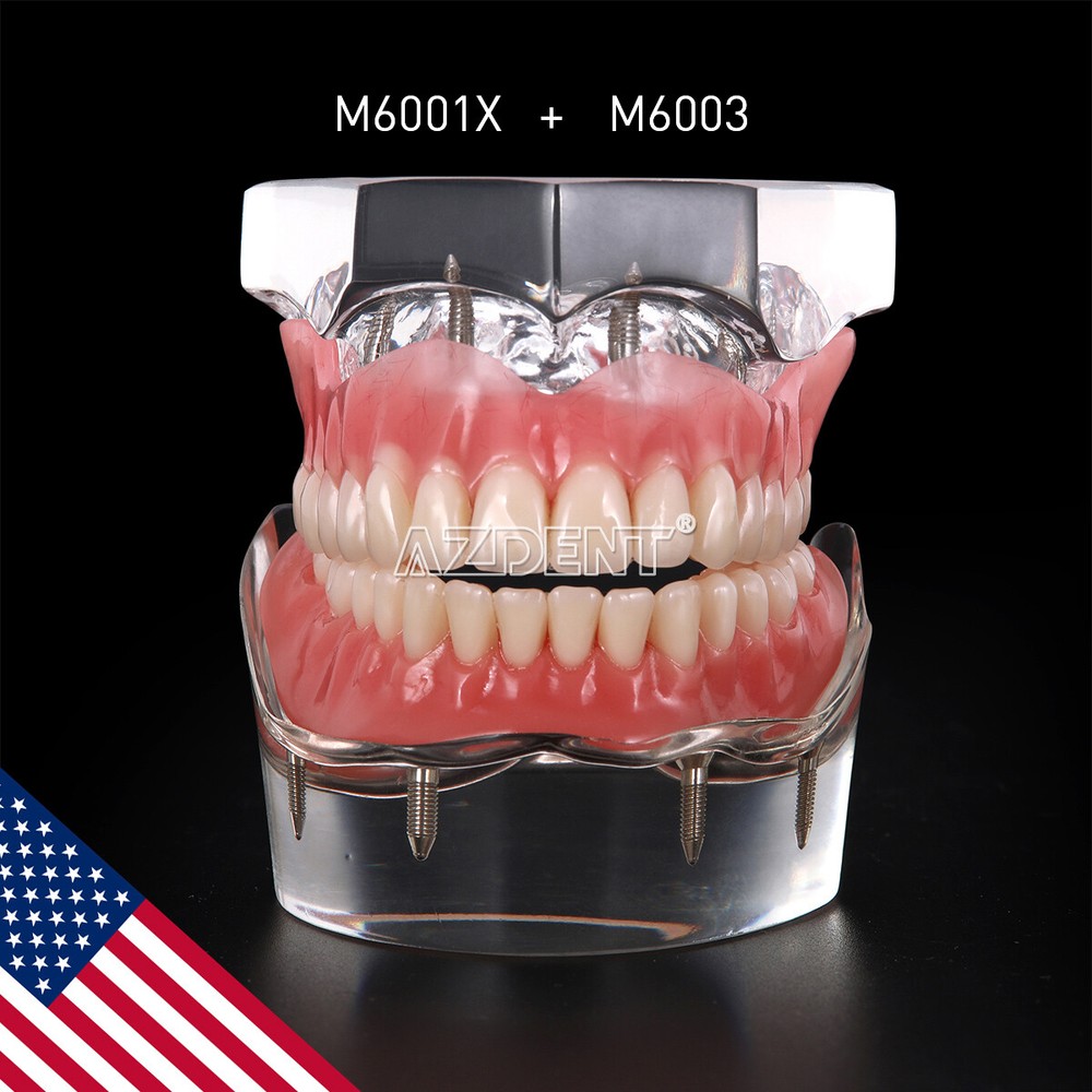 Dental Implant Teach Study Model Demo Overdenture Typodont 4Implants Upper Lower