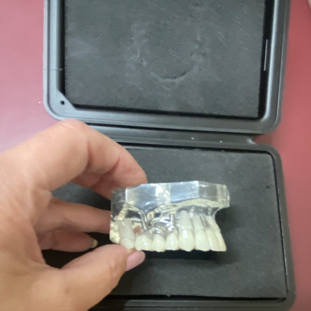 Practicon Transparent Implant Crown & Bridge Typodont Model 4071920 Dentistry