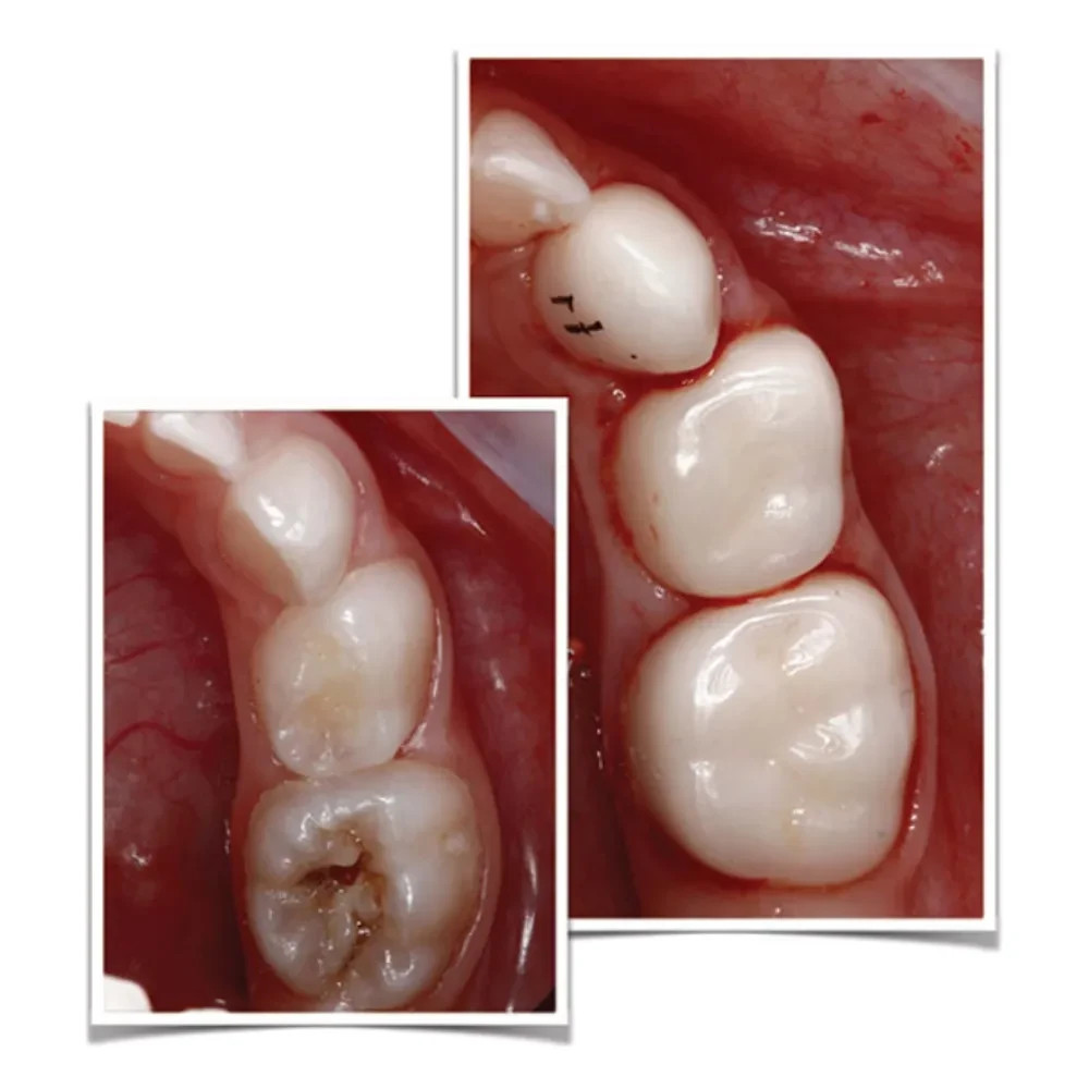 Kids-e-Crown Zirconia Upper Left 2nd Molar Refills