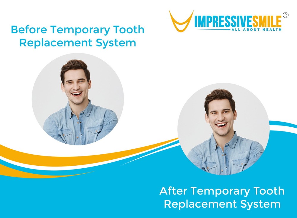 Patient Trusted Temporary Tooth Replacement System