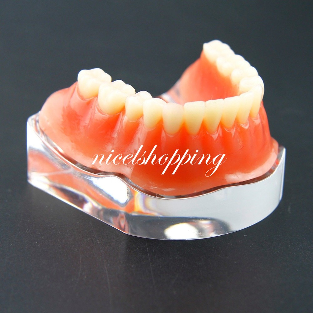 Dental Inferior Overdenture Model Lower Precision Implants With Silver Bar #6009