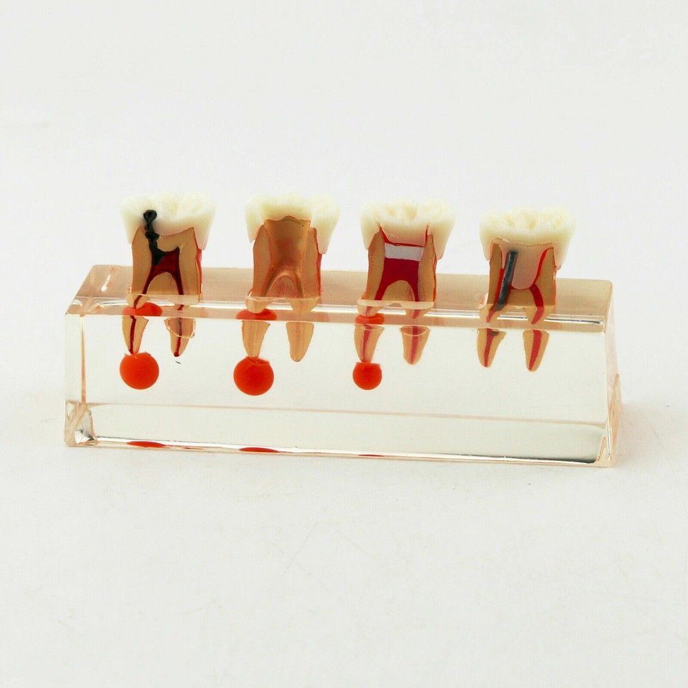 1 Pc Dental Study Typodont Teeth Model #4018 4 Stage Endodontic Treatment Model