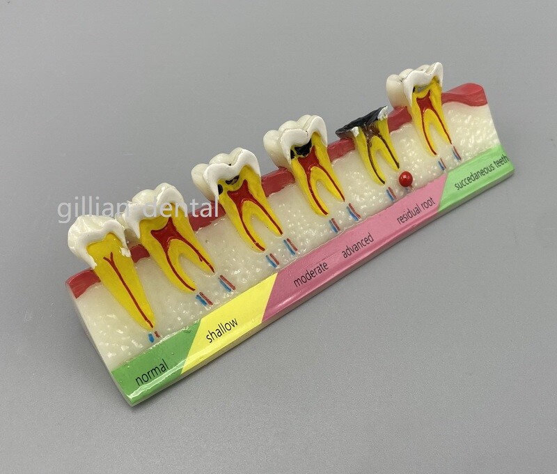 Dental Periodontal Caries Teeth Study Teaching Model Disease Assort Dentoform