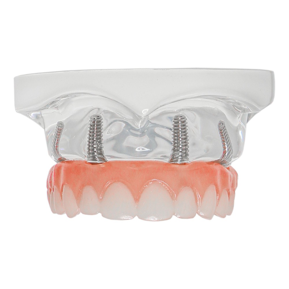 Implant Practice Demo Multiple Types Dental Teaching Teeth Model Typodont Ortho