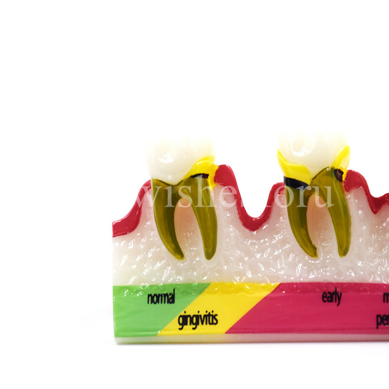 Dental Periodontal Disease Assort Developing Demonstration Teeth Study Model