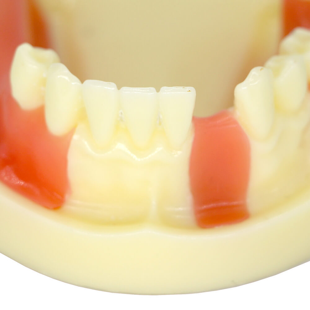 Dental Study Model with Bone Resorption & Missing Teeth for Implant Training