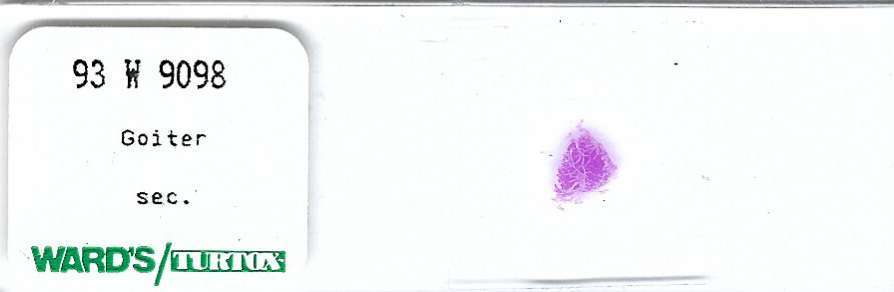 Human Goiter Pathology Microscope Slide