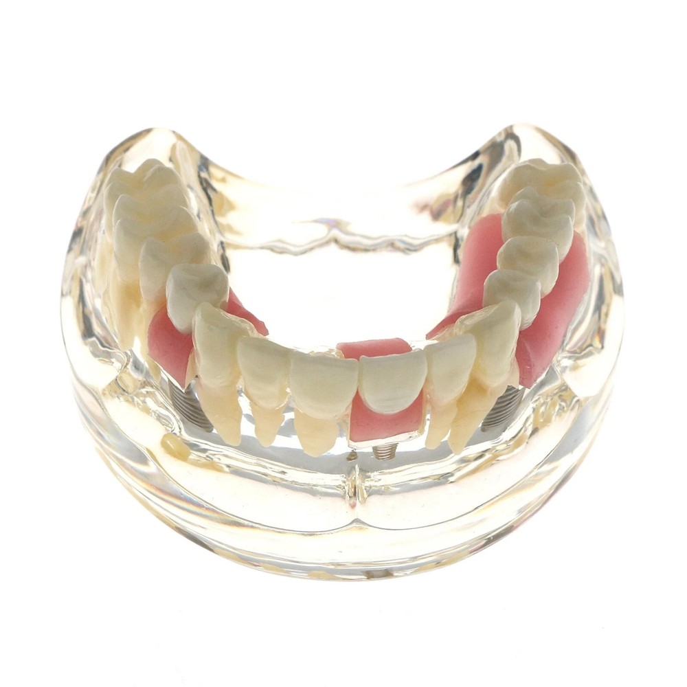 1Pcs Orthodontic Dental Implant Pathological Perio Practice Typodont Model M2005