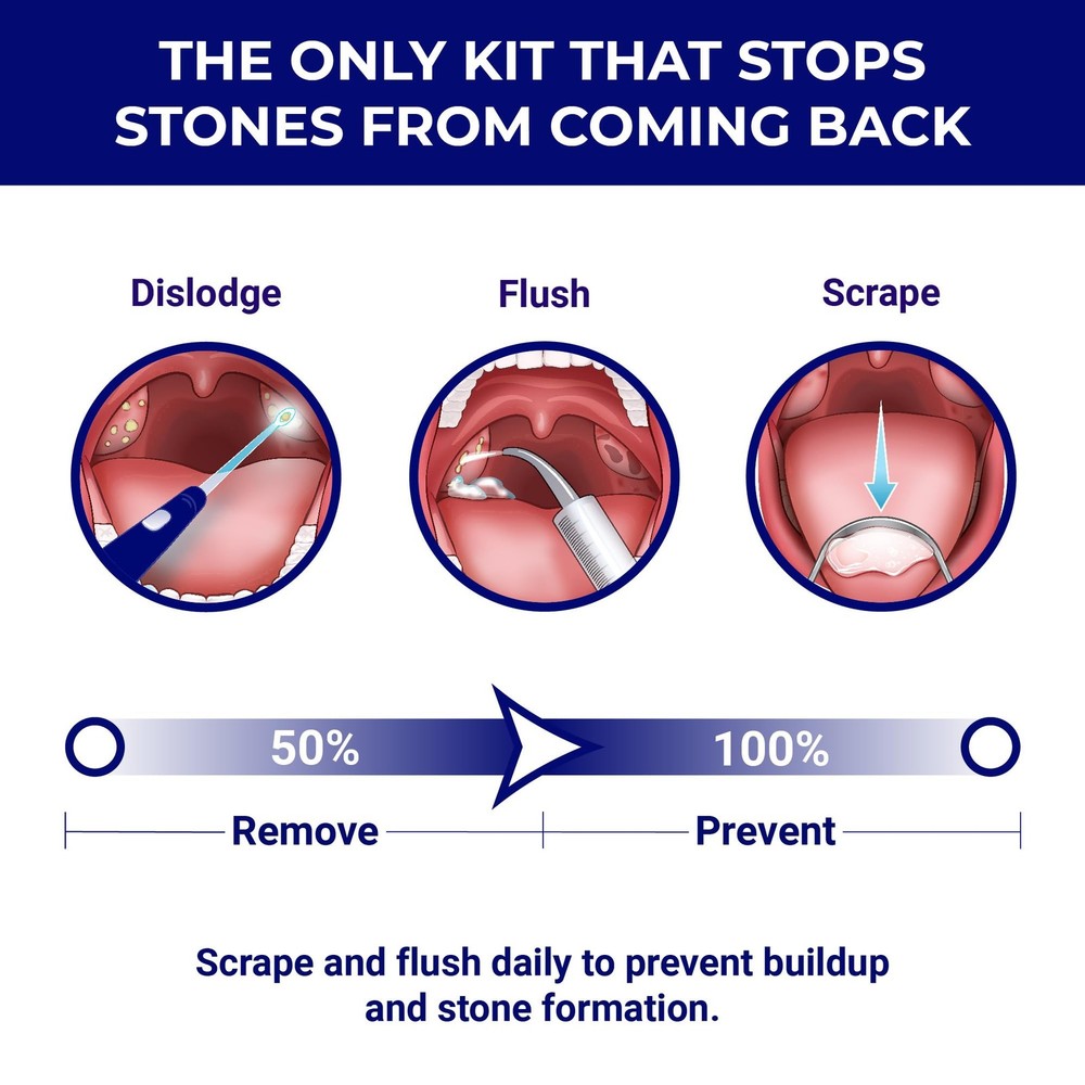ORAVIX Tonsil Stone Remover - Removal Kit - 7 Piece Set