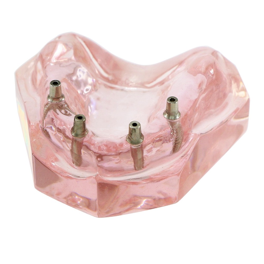 US Dental Implants Teeth Model Upper Lower Jaw 4/6 Overdenture Practice Demo