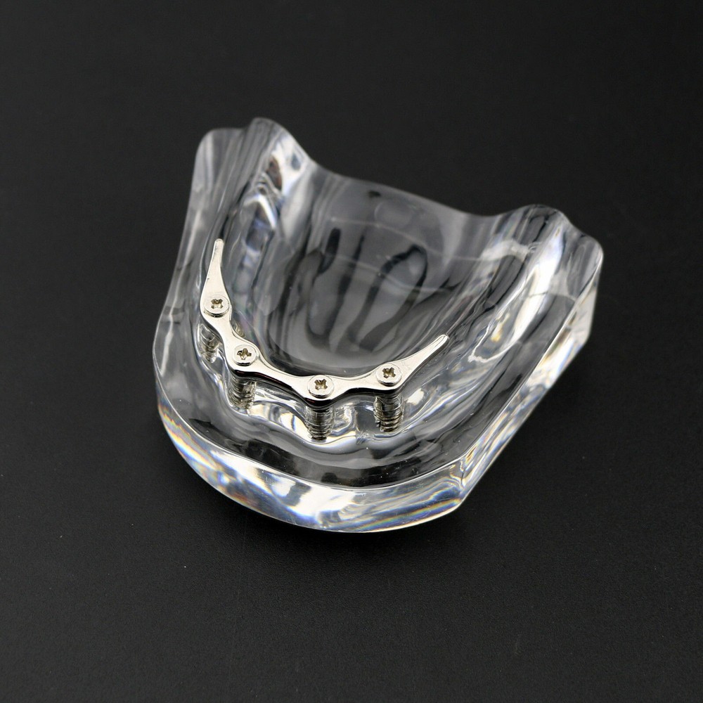 Dental Overdenture Study Demo Model Inferior M6008 Lower 4implants Silver Teeth