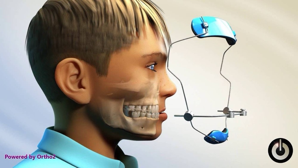 Wire Retainer With Hooks For Face Mask , Maxilla Forward Growth , Orthotics