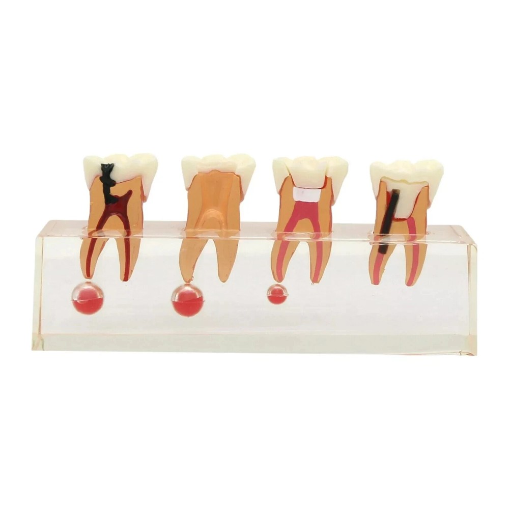 1x Endodontic Dental Demonstrates Typodont Teeth Model 4 Stage Study Model 4018