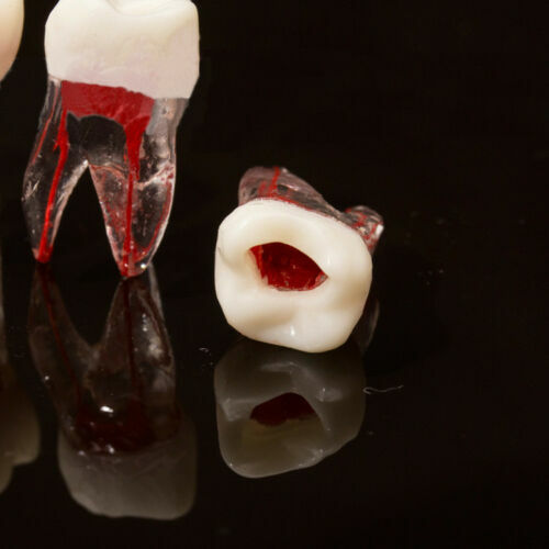 Dental Tooth Endo Root Canal Study Model RCT Practice Block Pulp Cavity