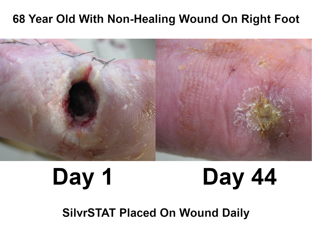 SilvrSTAT Antibacterial Wound Dressing Gel | ABL Med | *FACTORY DIRECT*