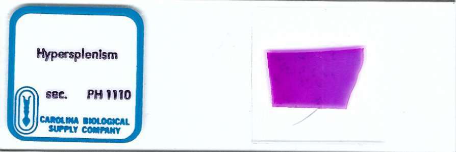 Human Hypersplenism Pathology Microscope Slide