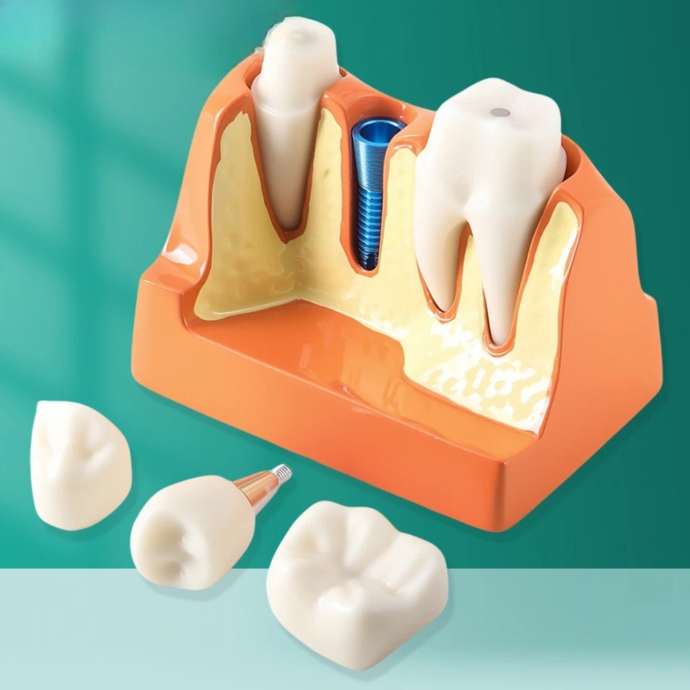 Dental Tooth Model Analysis Crown Bridge Demonstration Removable Caries Study