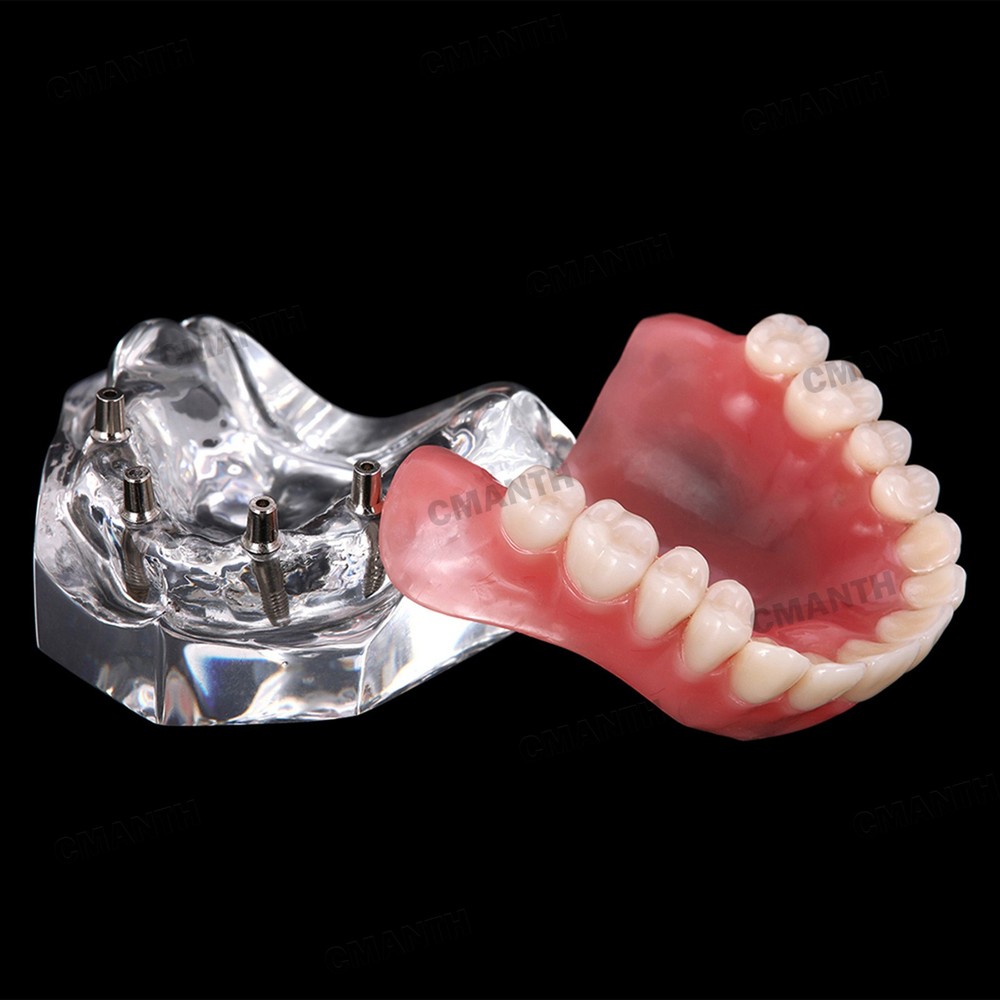 Dental Implant Teeth Model Overdenture Restoration with Upper Implants Demo