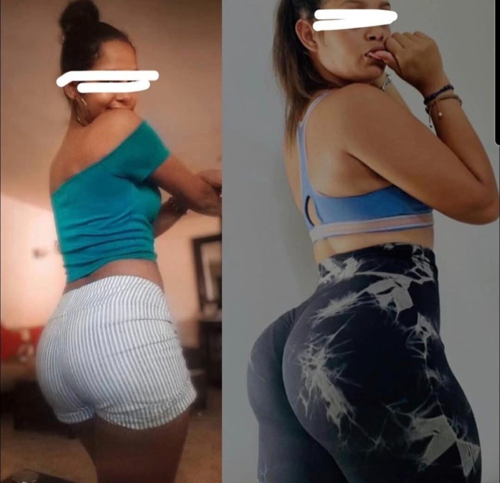 Buttocks Lift
