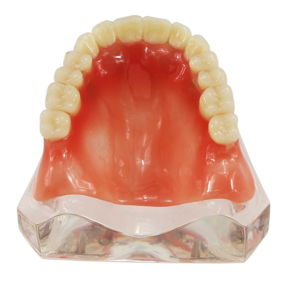 Detal Typondont Restoration Implant Overdenture Teeth Model 2 4 Implants
