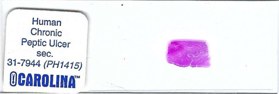 Human Chronic Peptic Ulcer Pathology Microscope Slide