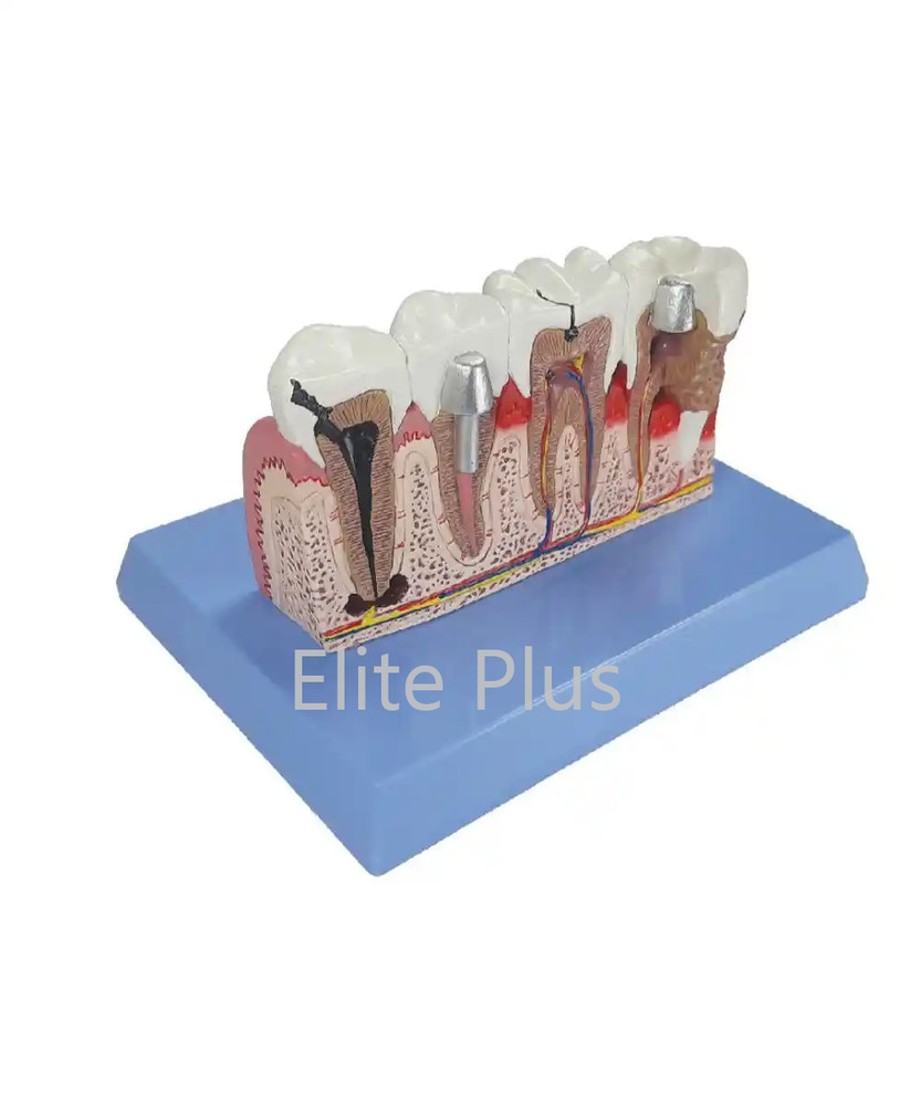 Teeth Pathologies Model ZX-1506P