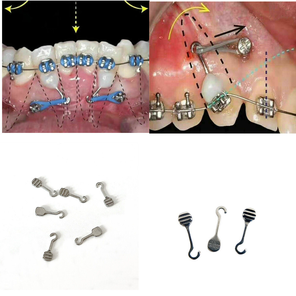 Dental Bonding Crimpable Hook Orthodontic Adhesive Hooks Arch Wire Left+Right