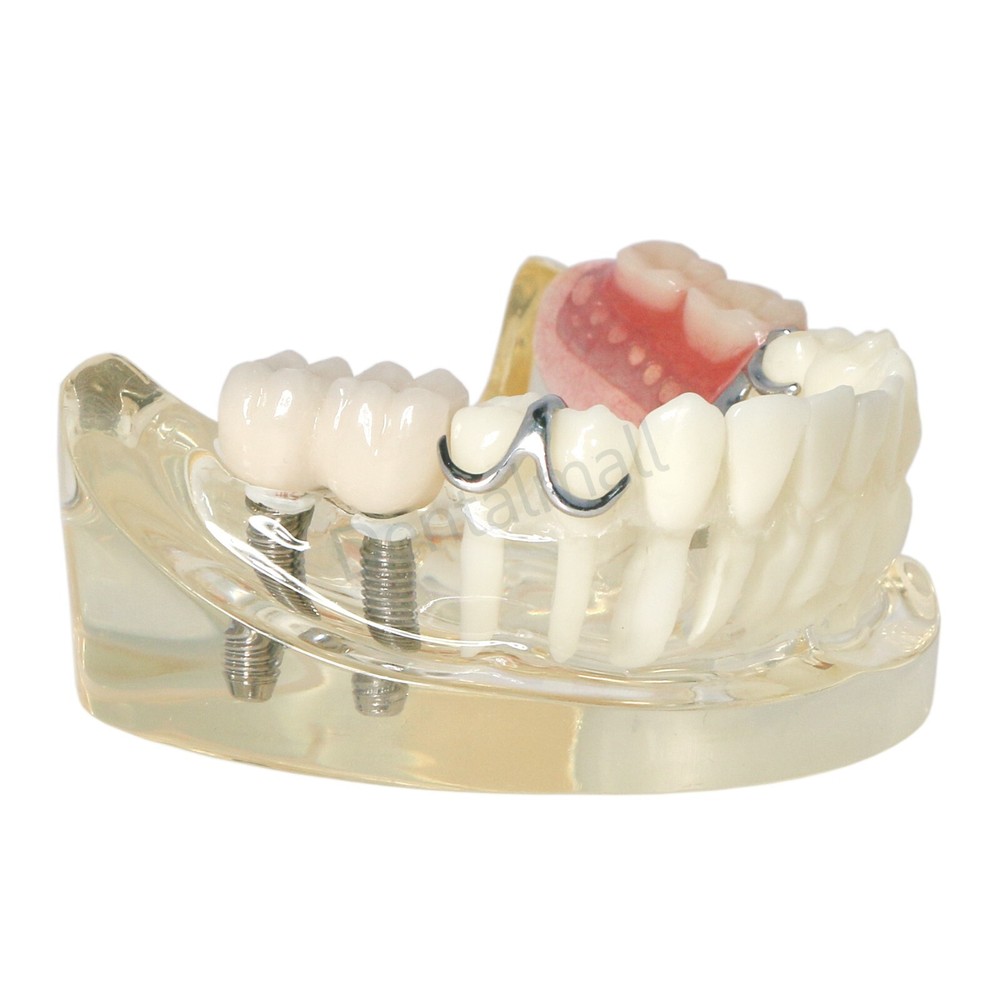 Dental Typodont Restoration Model With 2 Implants Partial Denture Demo