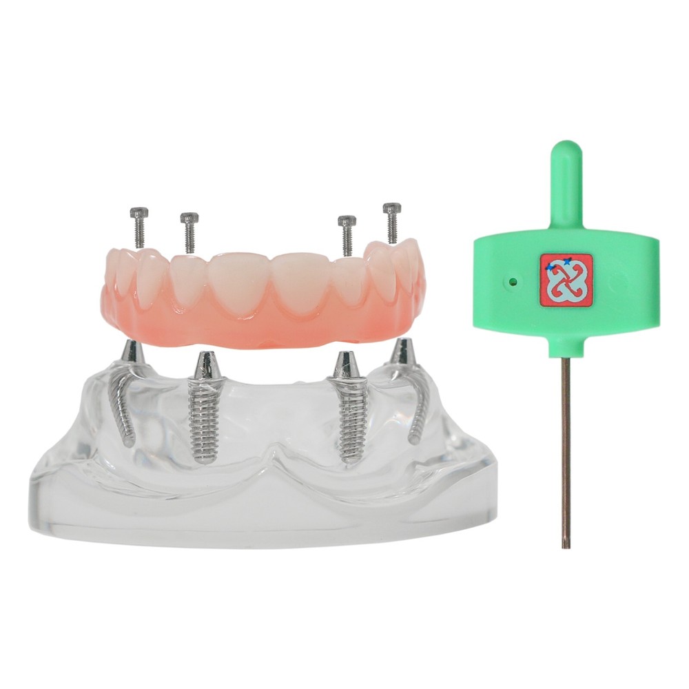 Dental Implant Disease Teeth Model Overdenture Implants Upper/Lower Demo