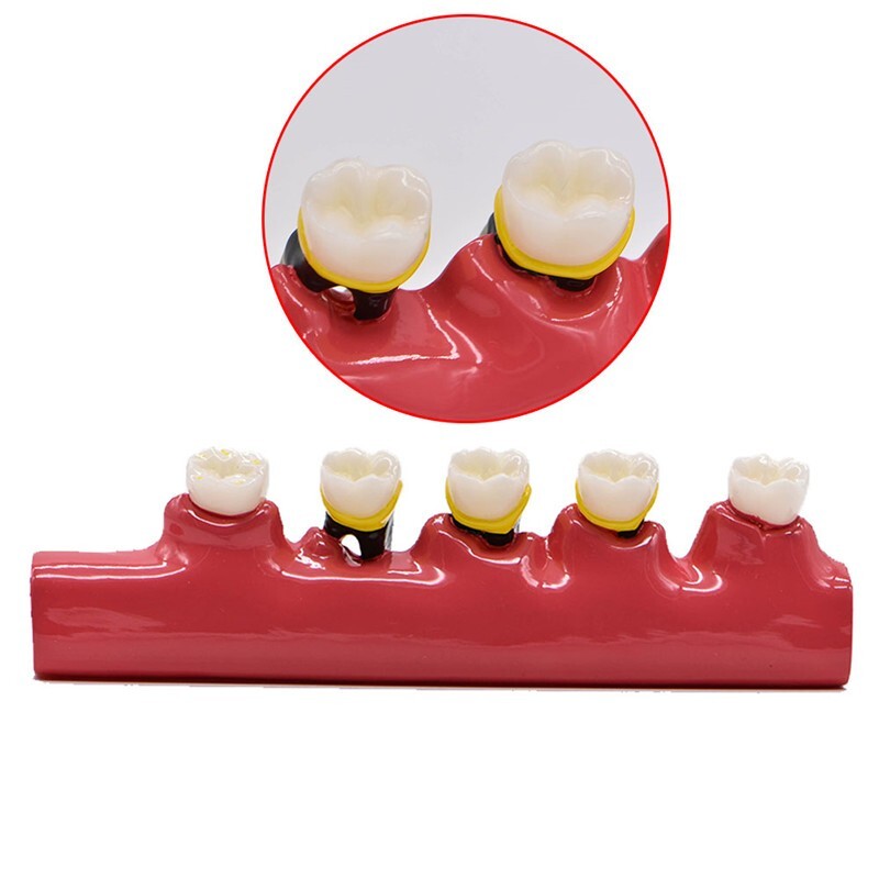 Dental Study Teaching Model Periodontal Disease Assort Teeth Dentoform Typodont