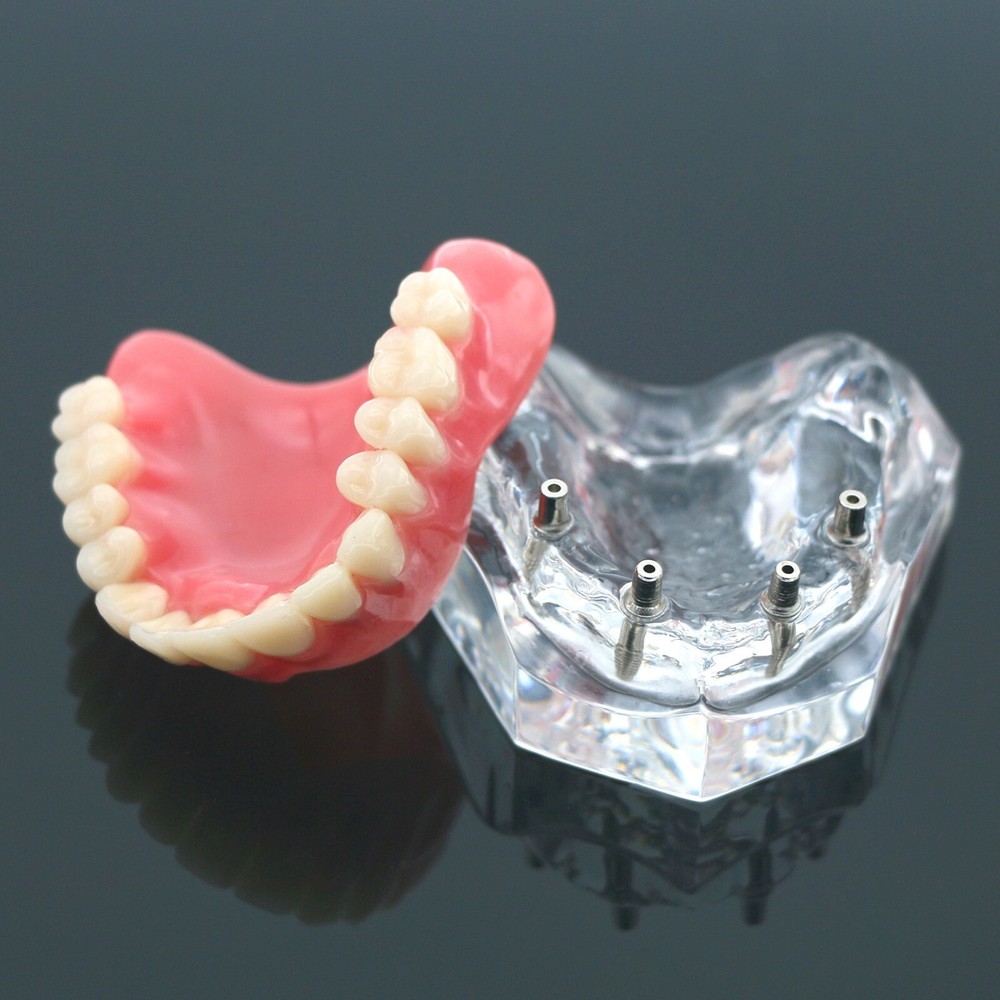 Detal Typondont Restoration Implant Overdenture Teeth Model 2 4 Implants