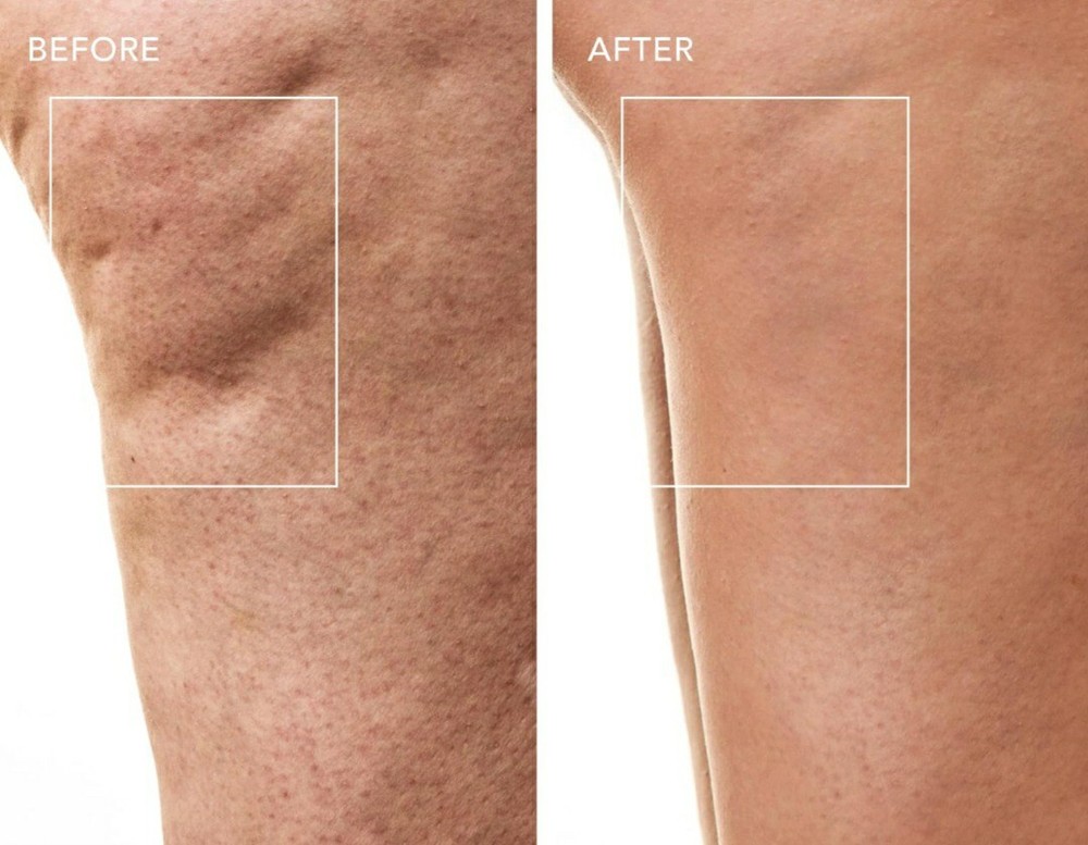 FOREO BEAR 2 BODY ADVANCED MICROCURRENT BODY TONING DEVICE IMPROVES WRINKLES