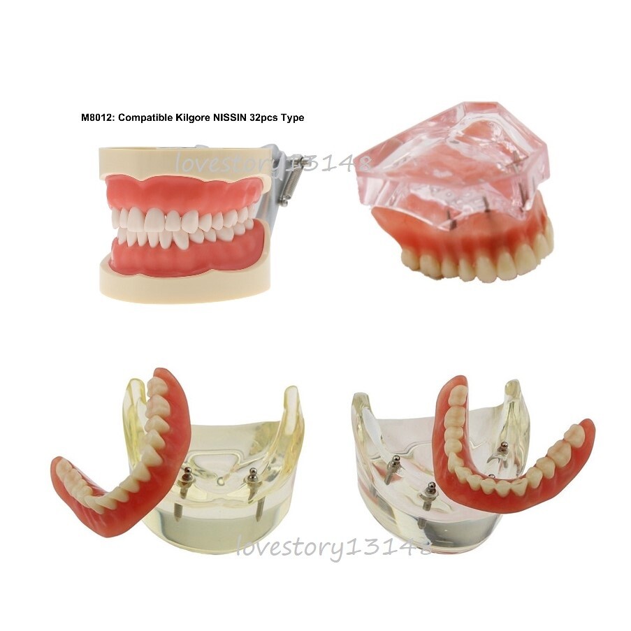 Dental Implant Teeth Model Demo Overdenture Restoration Teaching Study 4 Models