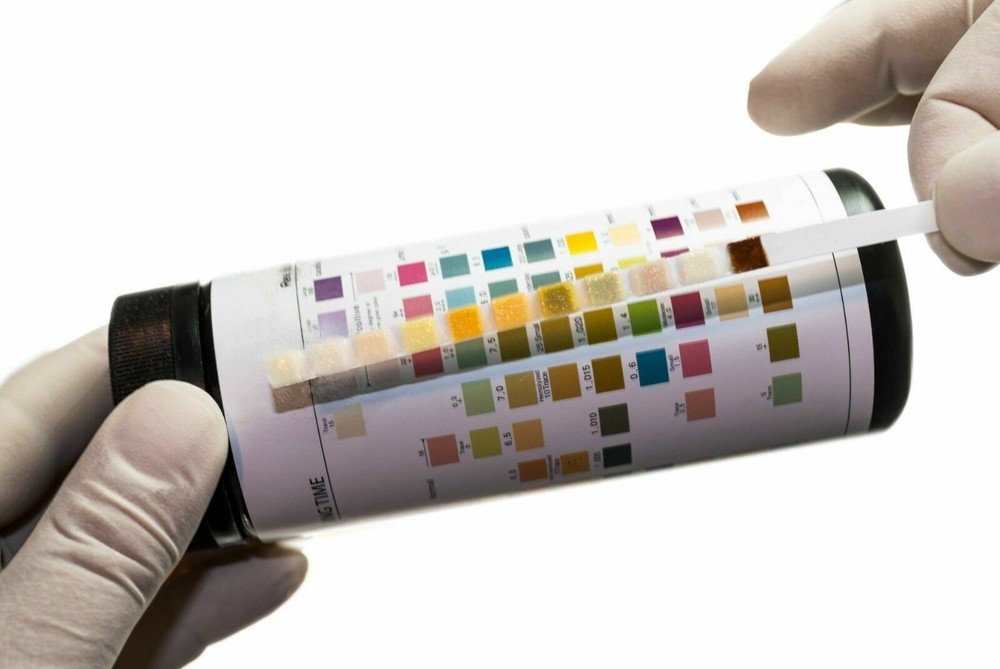 Urine Test Strips for Urinalysis 11 Parameters. 150 Cnt Urinalysis Test Strips