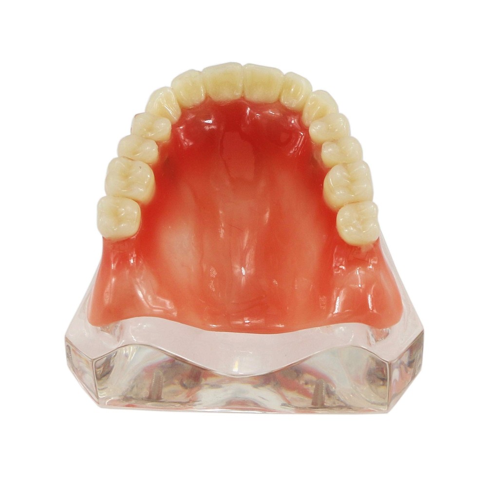 Dental Upper Implants Model Overdenture with 4 Superior Teeth Demo Transparen...