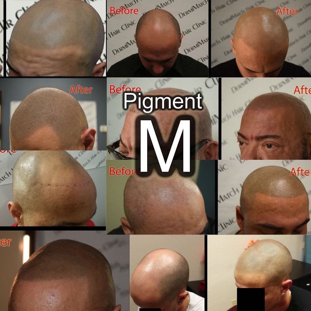 HD Scalp Micropigmentation Kit by DermiMatch