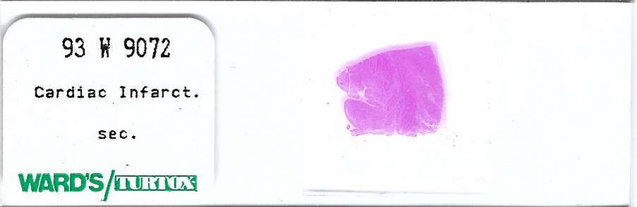 Human Cardiac Infarct Pathology Microscope Slide