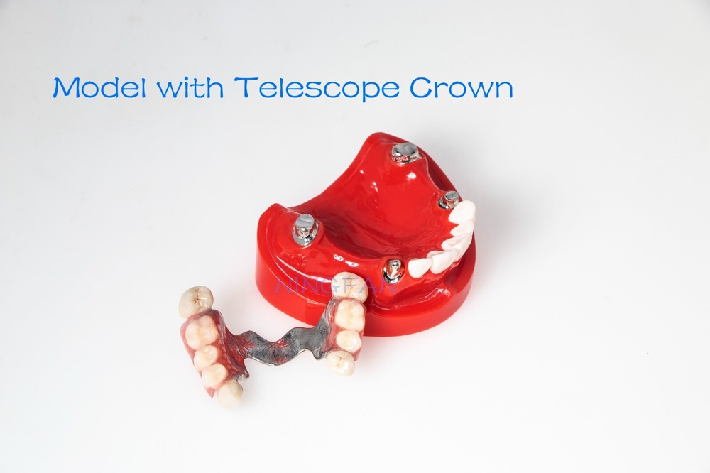 Dental Typodont Removable Partial Denture Model ,PRD Telescopic Crown Denture