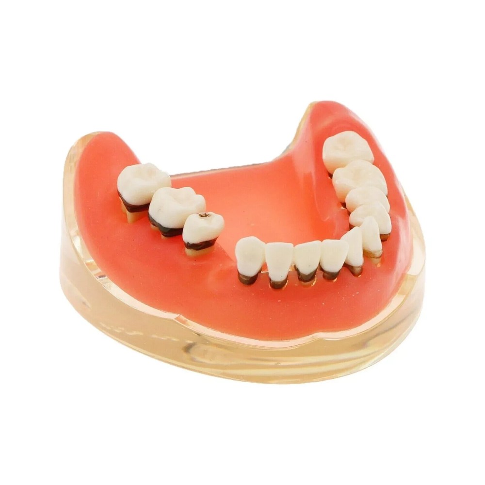 Dental Teeth Model Pathological Disease M4017 Removable Teaching Study Model