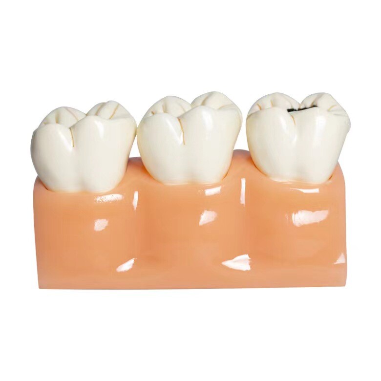 Dental Typodont Teeth Study Teach Tooth Model Implant Endo Caries Demonstration